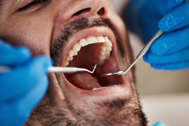 Best Emergency Dental Care for Broken or Chipped Teeth in Fairfield, OH